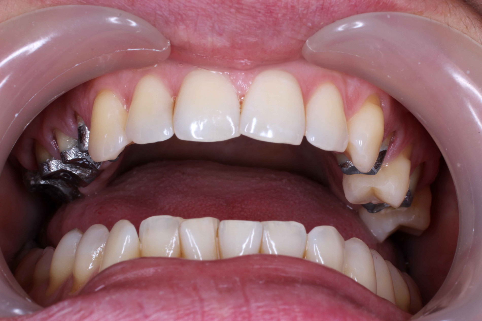Металлические зубные коронки