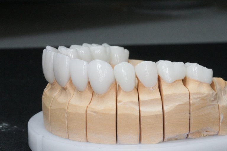 Зубные коронки: обзор и преимущества