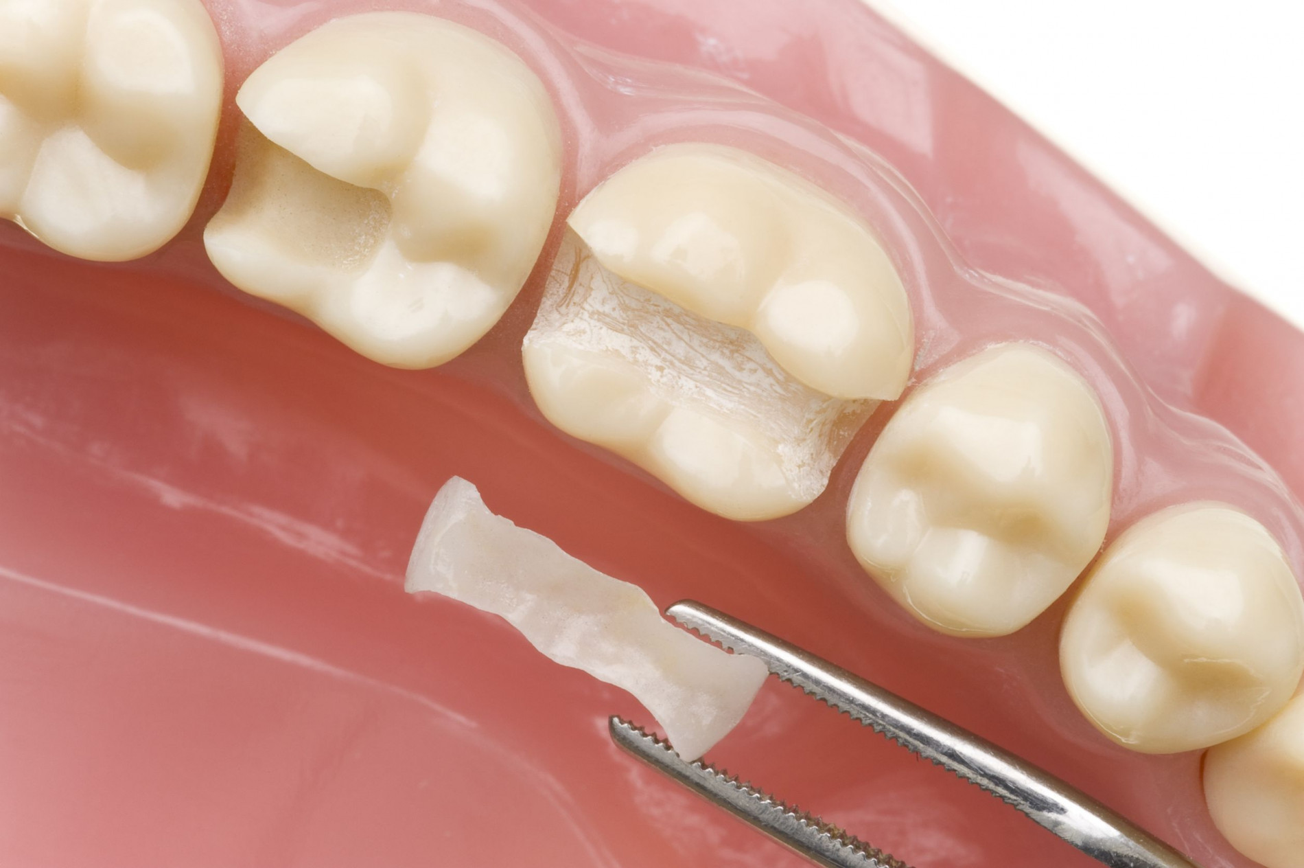 Какие способы протезирования зубов бывают с картинками