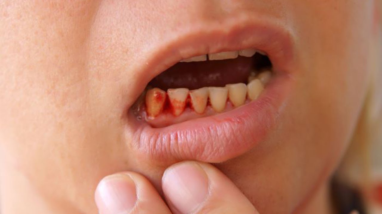 Кровоточивость десен: как бороться с кровью при чистке зубов?