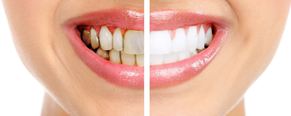 Профилактика почернения зубов