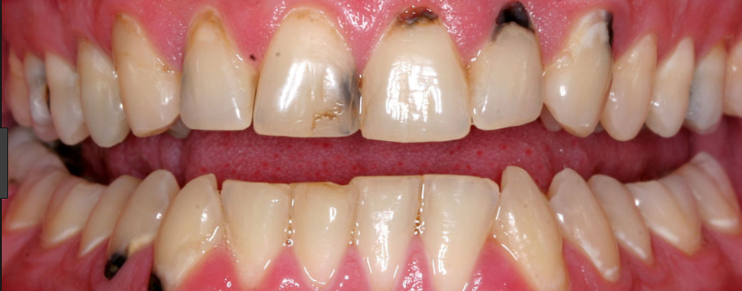 Причины почернения зубов