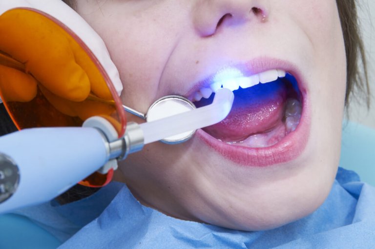 Лечение зубов пломбированием