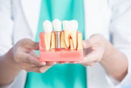 Какие зубные импланты лучше рейтинг 2020